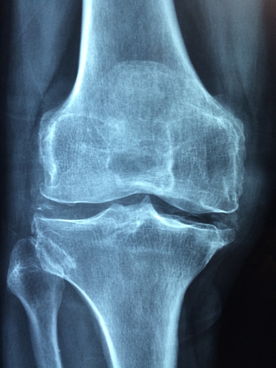 Ako bojovať proti osteoporóze? Riešením je účinná prevencia